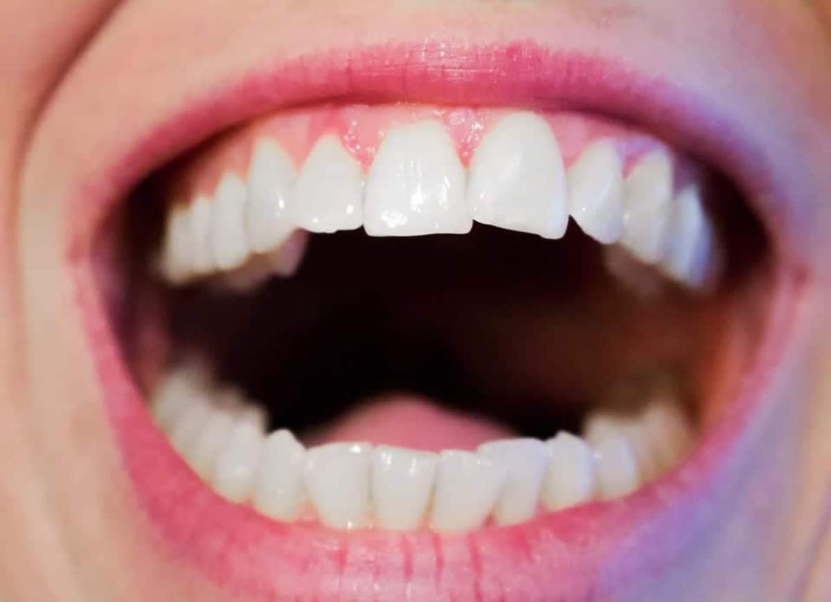 Un sourire éclatant.