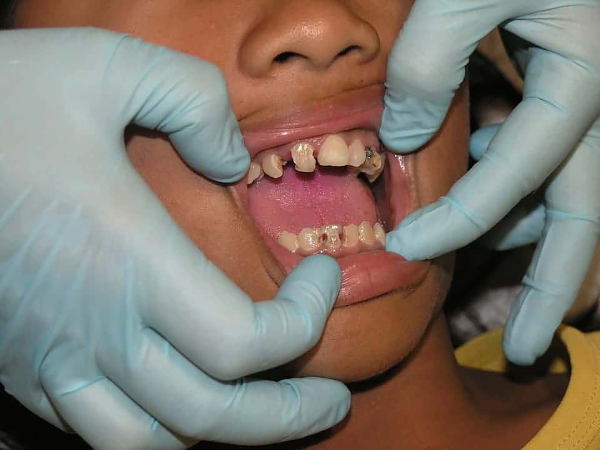 Dentition.