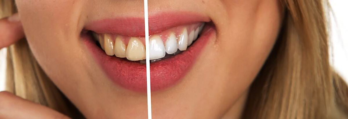 dents différentes